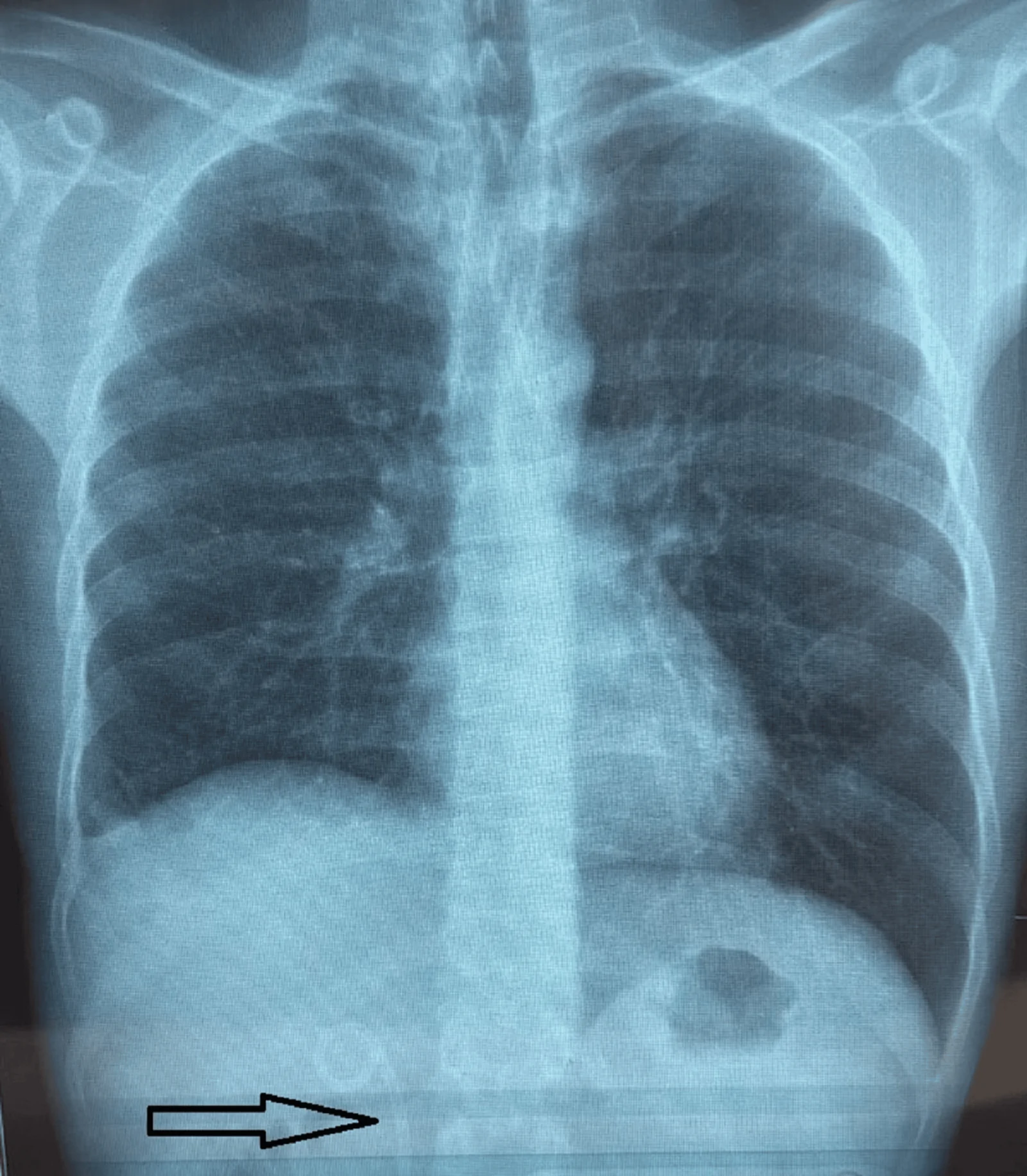X-ray showing CBD stent in situ (black arrow).CBD: common bile duct