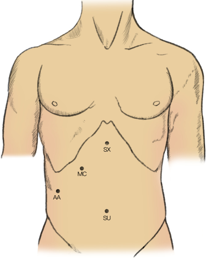 Positions of trocars
