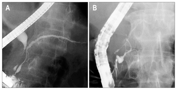 Main pancreatic duct opening sign showing that the main pancreatic duct within 1.5 cm from the orifice is maintained without irregular narrowing. The preserved main pancreatic duct is either (A) spindle-shaped or (B) cystic-shaped.