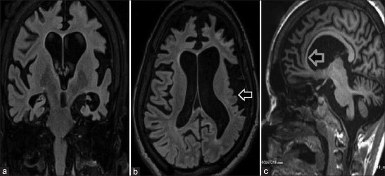 Coronal (a) and axial (b) sections show atrophy of bilateral cerebral hemispheres, predominantly affecting the left cerebral hemisphere with microgyria involving the left parietal and temporal lobes (white arrow). There is asymmetric dilatation of both the lateral ventricles (left is larger than right) as seen in coronal (a) and axial (b) sections. Sagittal section (c) shows thinning of the corpus callosum (gray arrow)