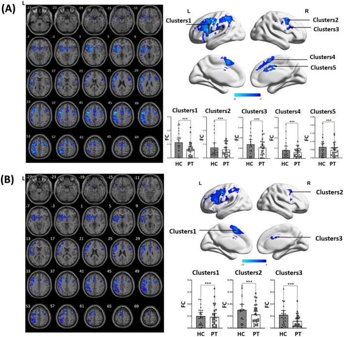 Brain regions demonstrating significant FC differences between stroke patients and healthy controls in ipsilesional (A) and contralesional (B) preSMA. The colored bars represent T values from the two‐sample t‐test. Cooler colors indicate lower FC values in stroke patients compared to healthy controls. L, left hemisphere; R, right hemisphere.