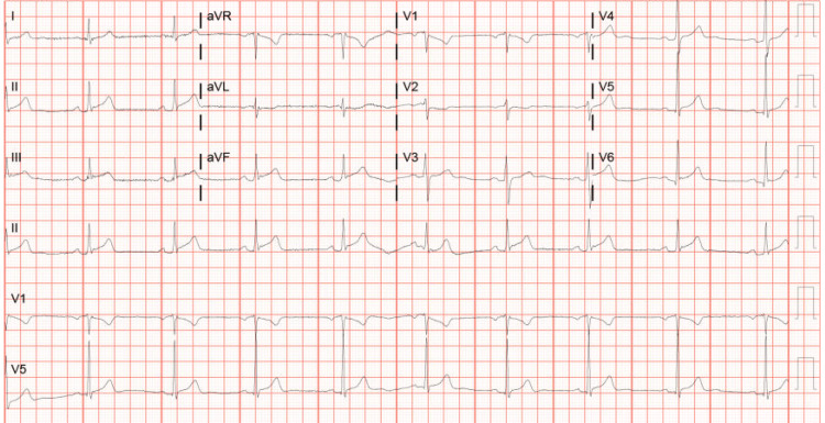 Serial EKG showing progressive changes in leads II, III, and aVFEKG: electrocardiogram