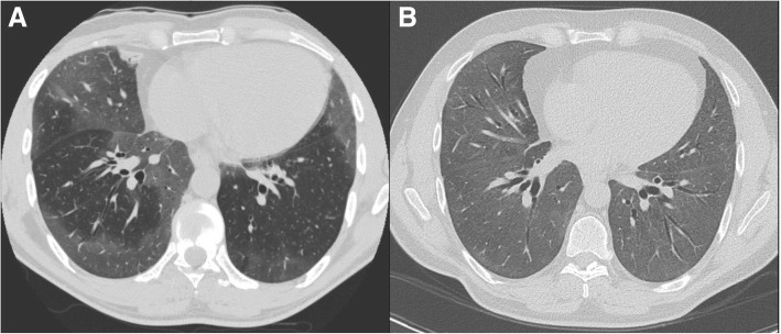 High-resolution computed tomography (HRCT) of the chest in axial cut from time of initial presentation (a), and 2 years post-diagnosis (b). Both HRCTs demonstrate multifocal ground glass consolidation, primarily in the lower lung zones, progressive over an 8-year period