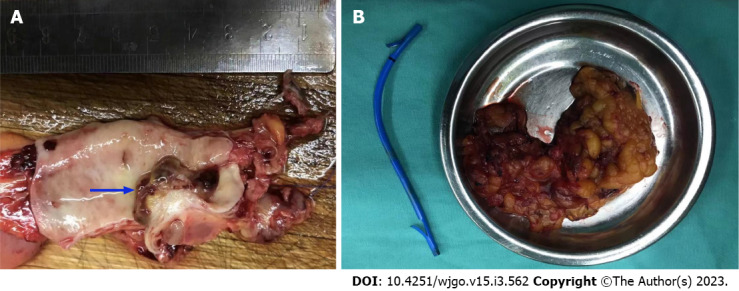 Intraoperative exploration revealed a tumor located in the middle and lower part of the common bile duct. A: Cauliflower-like new organisms approximately 2 cm × 1.5 cm with a hard texture; B: Cholecystectomy, common bile duct resection, and choledochojejunostomy were performed.