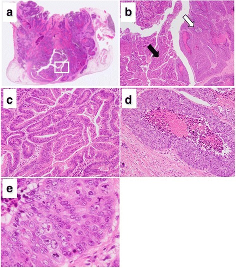 Pathologic examination of the resected specimen stained with hematoxylin and eosin. a Loupe image of the tumor revealed invasion throughout the entire CBD wall with serosal penetration. b Magnification of the part in the square in a. The tumor was structured with two components (black and white arrows). There was no transitional area between the two components. c Intermediate-magnification image of the part marked with a black arrow showed moderate differentiated adenocarcinoma. d The intermediate-magnification image of the part marked with a white arrow shows LCNEC, which made up approximately 90% of the tumor. The tumor was solid and cellular with necrosis inside. The tumor cells were joined together, and the cytoplasm was relatively large. e A high magnification of d shows that each nucleus variant was large and the heteromorphic nuclei division image was obvious