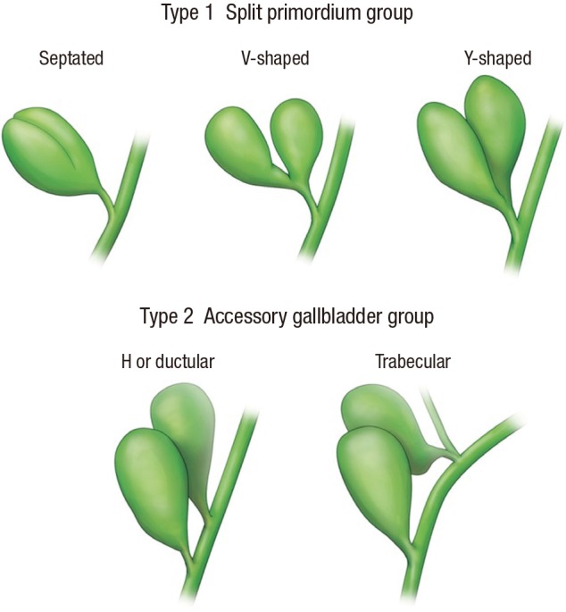Classification of duplicated GB. Adapted from Harlaftis et al. (1).GB = gallbladder.