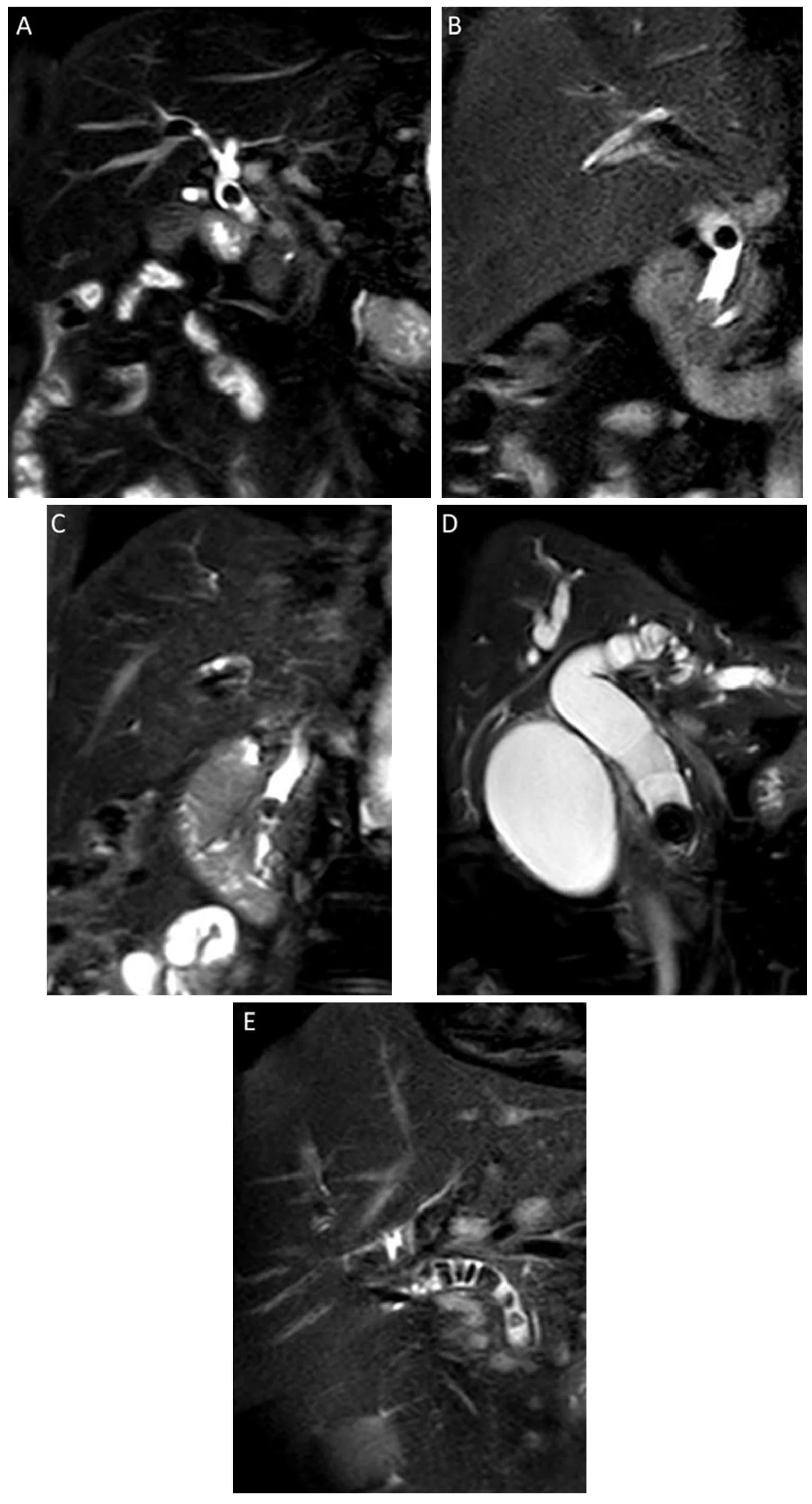 Coronal MRCP images illustrating CBD stone locations: (A) proximal, (B) middle, (C) distal, (D) impacted at the ampulla, and (E) multisegment.