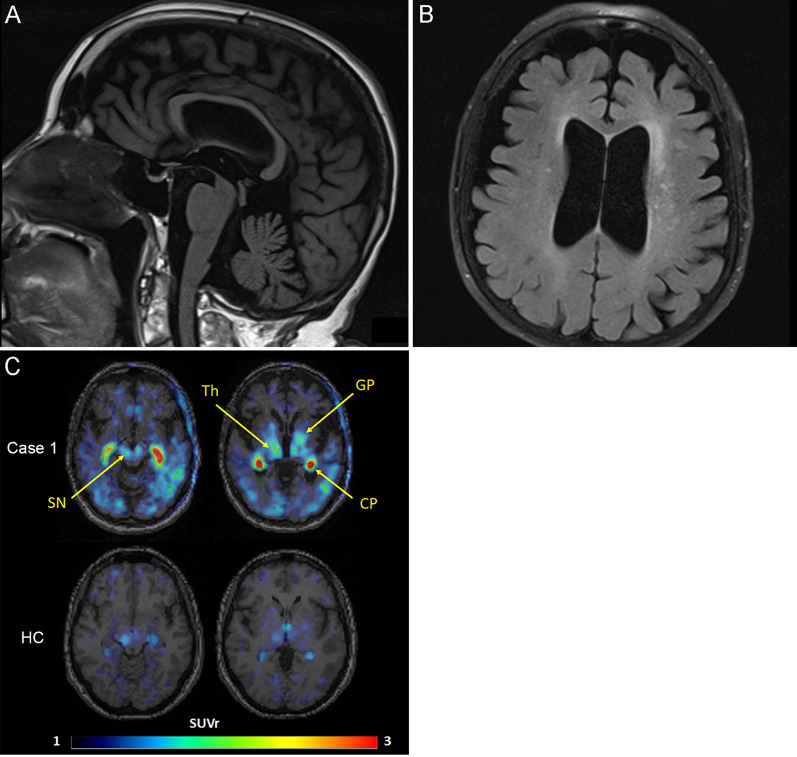 Representative images of brain MRI and tau PET. A The sagittal T1-weighted FLAIR image demonstrates atrophy of the midbrain. B The axial T2-FLAIR image displays asymmetrical cerebral atrophy with left-sided predominance, white matter hyperintensities, and dilation of the lateral ventricles. C Representative images of [18F]APN-1607 of Case 1 and a 54-year-old healthy female (HC). [18F]APN-1607 uptake is moderately increased in the globus pallidus, thalamus, and substantia nigra (indicated by arrows), compared to the HC. The two intense spots represent signal in choroid plexus (CP), which is non-specific and is occasionally seen in some patients and controls. The SUVr intensity color scale is shown at the bottom