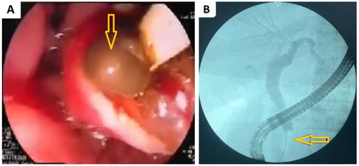 Shows (A) endoscopic retrograde cholangiopancreatography (ERCP) showing a stone (arrow) was impacted in the ampulla of Vater obstructing the bile ducts; (B) cholangiogram of ERCP showing multiple stones (arrow) in the distal common bile causing obstruction and dilatation.