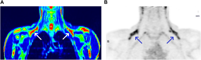 PET/MRI and PET scans of a BAT (+) individual [panel (A,B), respectively]. Arrows show BAT areas in supraclavicular regions.