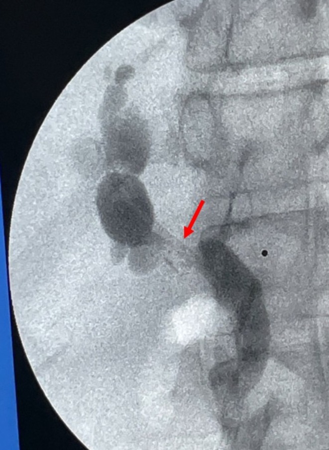 Repeat image of anastomotic stricture (red arrow) after placement of 10 cm 7fr plastic stent. Red arrow, anastomotic stricture.