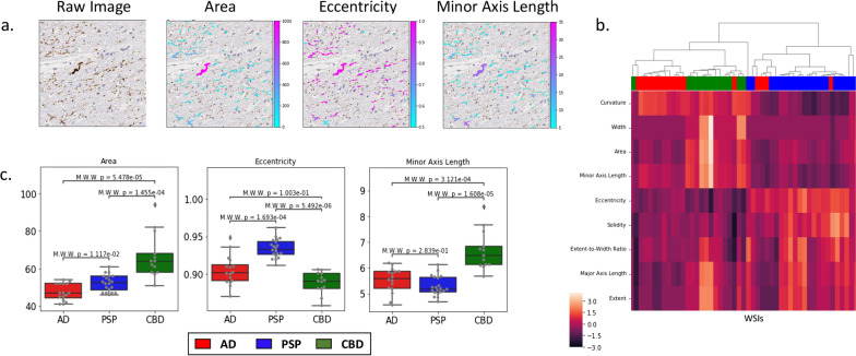 Aggregates from different diseases show distinct shapes and sizes. Individual aggregates were identified in the WM of WSI and were characterized by features describing their size and shape. a Example image patch (left) from a WSI with individual aggregates colored based on sample features: area, eccentricity, and minor axis length. b Individual WSI (rows) were characterized based on median feature values (columns) of aggregates in their WM and were ordered based on hierarchical clustering. Values within each feature were z-score normalized to allow comparison across features. Colors on top (Red/blue/green) indicate disease associated with each WSI. c Boxplots of median feature values for area, eccentricity, and minor axis length shown in WM regions of WSI (gray dots) compared across each disease. Mann–Whitney test, with Bonferroni-based multiple-hypothesis testing correction (across diseases) was used for statistical comparison