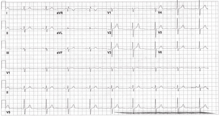 EKG done at 14:43 on day 1 of admission, showing normal EKG with sinus bradycardia and resolution of incomplete RBBB.EKG = electrocardiogram; RBBB = right bundle branch block