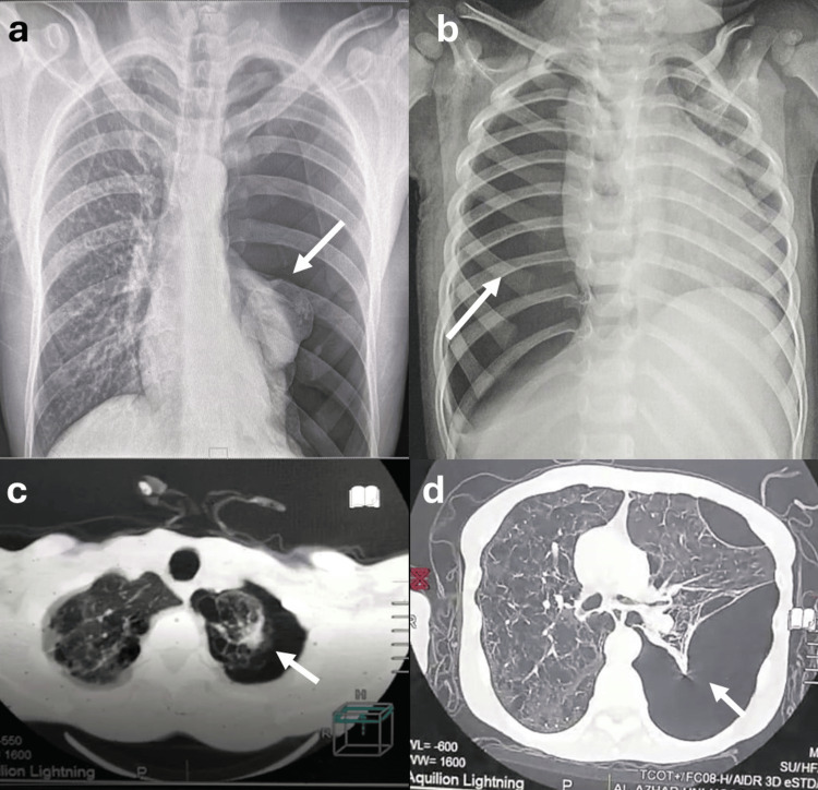 (a) X-ray of the chest (arrow indicates left side tension primary spontaneous pneumothorax); (b) X-ray of the chest (arrow indicates right side tension primary spontaneous pneumothorax); (c and d) CT of the chest (arrows indicate left side secondary spontaneous pneumothorax).