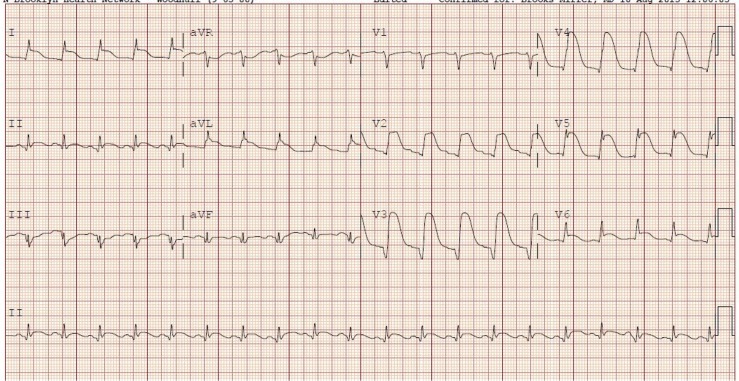 Initial ECG demonstrating ST-segment elevation in multiple leads.