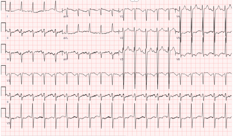 Electrocardiogram #1The findings show sinus tachycardia (heart rate 120); left axis deviation; left anterior fascicular block; and LVH with repolarization abnormalitiesLVH: left ventricular hypertrophy