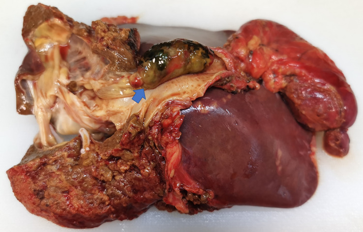 Macroscopic image of the specimen with the tumor within the common bile duct.