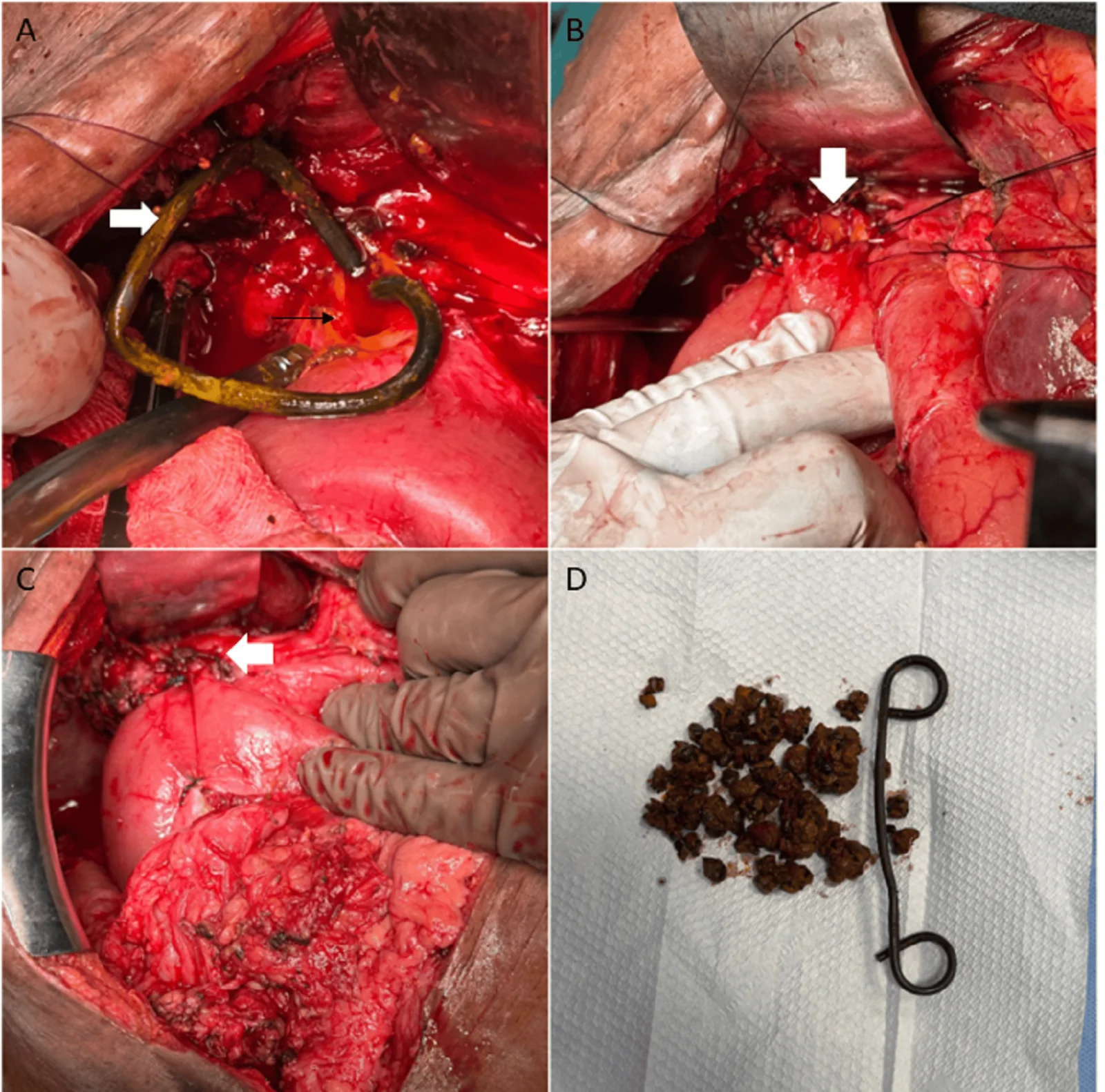 Intraoperative images of retrieved plastic biliary stent with heavy encrustation and multiple CBD calculi.(A) Choledochotomy site (black arrow) and retrieval of retained stent (white arrow). (B, C) Choledochoduodenostomy anastomosis (white arrow). (D) Retained stent along with stones.CBD: common bile duct