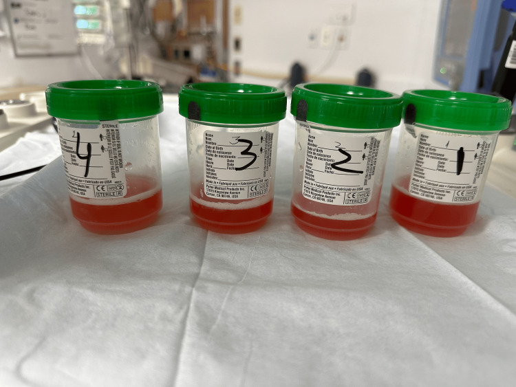 Bronchoalveolar lavage obtain during bronchoscopySerial bloody aliquots