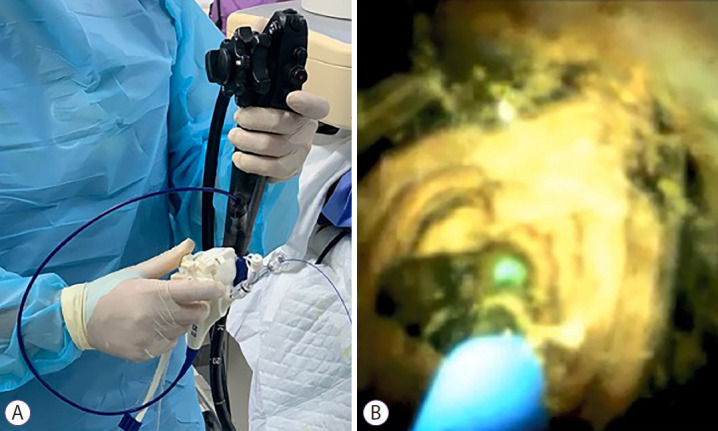 Laser lithotripsy guided by single-operator cholangioscopy. (A) A disposable cholangioscope operated by a single endoscopist. The laser probe is inserted through the accessory channel of the cholangioscope, which is inserted through the accessory channel of the duodenoscope. (B) Cholangioscopic view of intraductal stone fragmentation with a laser probe.