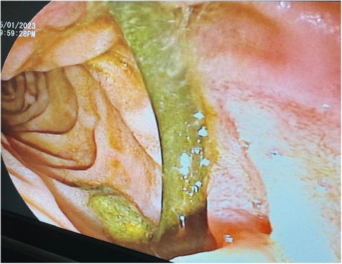 Endoscopic image of the stent in situ.