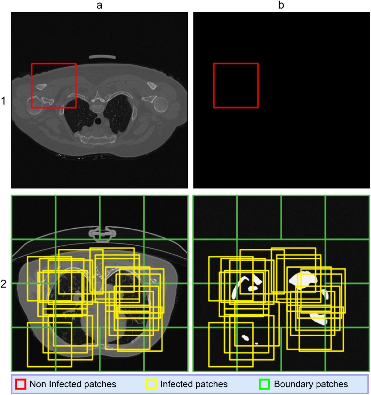 Row 1: Patch extraction from training CT slices, depicting no infected regions. 1(a) Non-infected patches, and 1(b) corresponding annotated masks. Row 2: Patch extraction from training CT slices, depicting infected regions. 2(a) Overlapping patches, and 2(b) mapping to corresponding annotated masks.