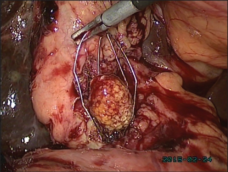 Stone impacted with basket is being released after choledochotomy. Dilated bile duct is being seen with liver in background