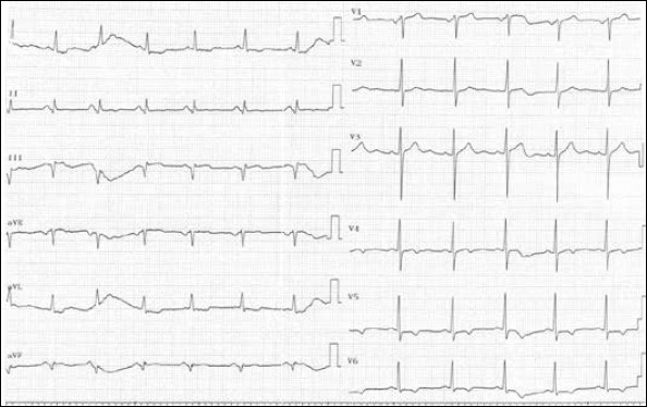 ST-segment resolution after primary percutaneous coronary intervention