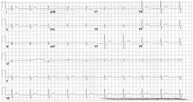 EKG done on day 2 of admission, showing borderline EKG with sinus bradycardia and incomplete RBBB.EKG = electrocardiogram; RBBB = right bundle branch block