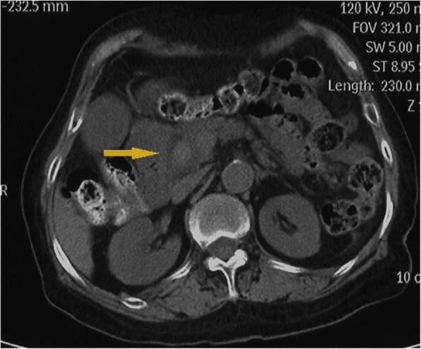 A high-density image of the middle CBD with a markedly dilated biliary tree on the second CT