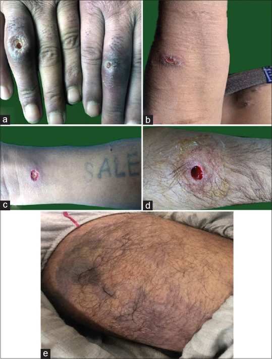 Active skin ulcers and skin and soft tissue infections at the injection site present in patients using injectable heroin (a-e)