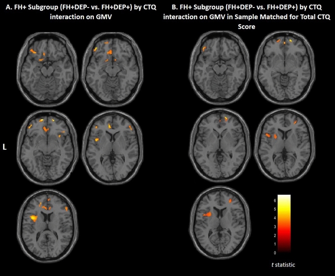 Areas of gray matter volume that showed childhood maltreatment by FH+ subgroups (FH+DEP−, FH+DEP+) interaction. (A) Axial-oblique images show regional gray matter volume (GMV) that showed a significant family history positive (FH+) subgroup by Childhood Trauma Questionnaire (CTQ) total score interaction. Higher CTQ score correlated with lower GMV in FH+ individuals with a history of unipolar depression (FH+DEP+), and conversely, greater GMV, or no significant relation, in these clusters in FH+ individuals without a history of unipolar depression (FH+DEP−). Total N = 21; FH+DEP−: N = 9; FH+DEP+: N = 12. (B) Axial-oblique images show regional GMV that showed a significant bipolar disorder FH+ subgroup by CTQ total score interaction when removing the four individuals with highest CTQ scores in the FH+DEP+ subgroup so groups were matched on total CTQ scores. Higher CTQ score was related to lower GMV in FH+DEP+ individuals, and conversely, greater GMV, or no significant relation, in these clusters in FH+DEP− individuals. Total N = 17; FH+DEP−: N = 9; FH+DEP+: N = 8). Significance threshold is p < 0.005, uncorrected; clusters > 20 voxels. Left of figure denotes left side of brain. Color bar represents range of T values.