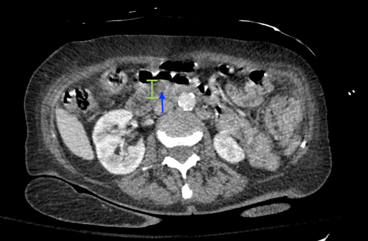 CT scan of the abdomen/pelvis showing increased dilatation of the common bile duct measuring up to 9 mm (green distance marker), and a subtle area of hyperattenuation measuring 5 mm (blue arrow) within the distal common bile duct