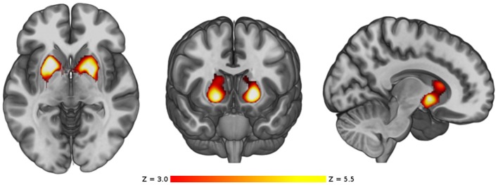 VBM comparison between the cannabis users and the control group HC1. Regions showing significant larger volume in the cannabis users are shown in red-yellow. The color-bar shows the z-score scale. The right side of the images represents the right side of the brain.