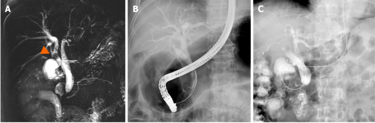 Magnetic resonance cholangiopancreatography. A: Magnetic resonance cholangiopancreatography showed duplicated common bile duct (CBD) independently draining the left and the right robes of the liver, to create a short segment intrapancreatic CBD without communicating channel. Residual stones were identified in the right CBD (white arrowhead); B: Both CBD was accessed using guidewire on Endoscopic retrograde cholangiopancreatography; and C: No definite filling defects were identified in both CBD on tubography using an endoscopic nasobiliary drainage.