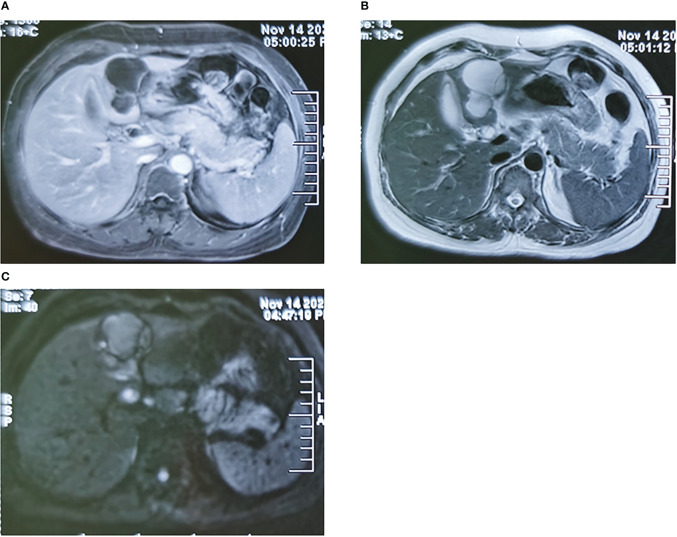 Typical images of magnetic resonance imaging of the liver lesions. (A) The arterial phase image of the liver lesions. (B) The T2 phase image of the liver lesions. (C) The DWI phase image of the liver lesions. DWI, diffusion-weighted imaging.