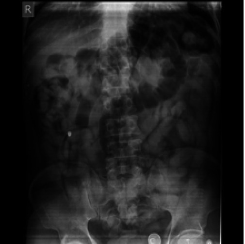 Abdominal radiograph showing multiple well circumscribed foreign bodies.
