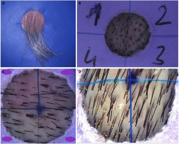 (A) A cardboard template with a circle-shaped hole of approximately 1 cm2 in its middle placed on the area to be examined. (B) A template with a circle-shaped hole equivalent to the area analyzed by TrichoScan divided into four equal sections by using two strings and placed on the examination area. (C) Digital trichoscopic photographs with a 20-fold magnification obtained from the examination area. (D) Vellus hairs marked with red dots and terminal hairs with yellow dots using Microsoft Paint program on trichoscopic images.