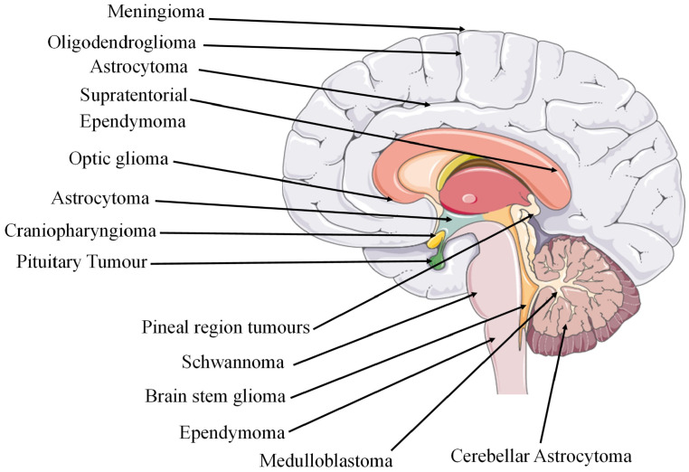 Sites of cancerous tumours in the brain region [68]. The figure contains modified images from Servier Medical Art (https://smart.servier.com, accessed on 5 July 2023) licensed by a Creative Commons Attribution 3.0 Unported License.