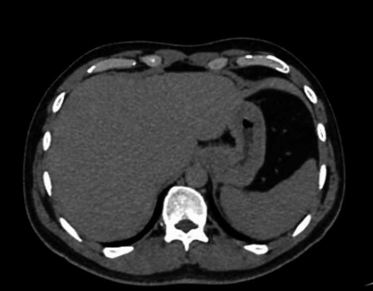Normal abdominal CT scanCT: computed tomography