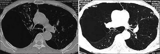 CT scan demonstrating giant bullae with compression of the lung parenchyma