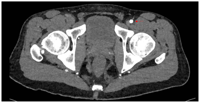 Computed tomography angiography demonstrating occlusion of the right and a normal left common femoral artery (red arrow).