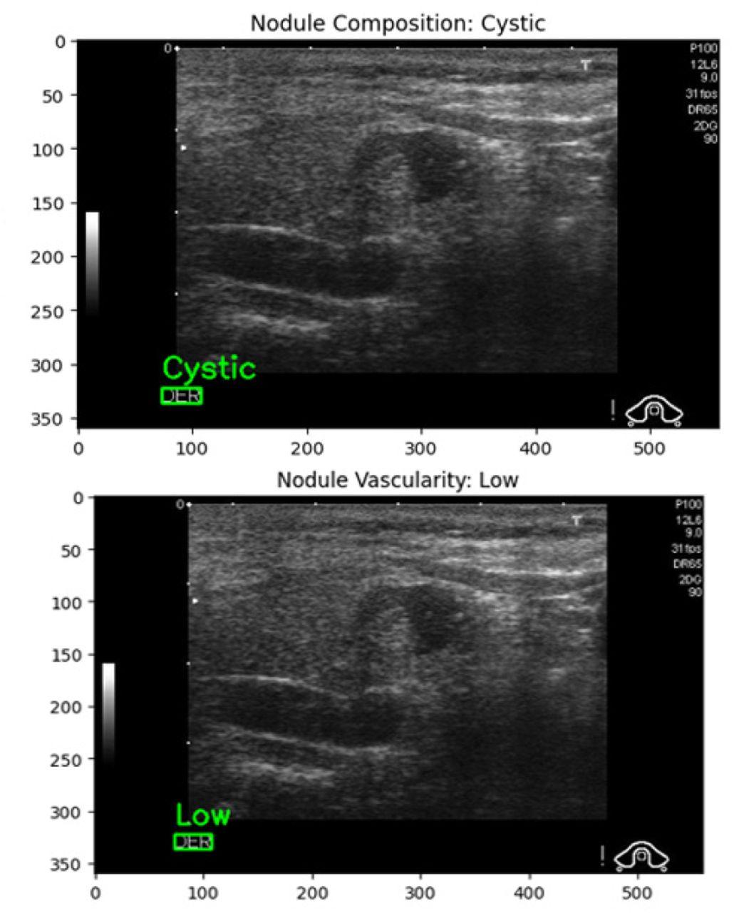 Vascularity Analysis Of Nodule