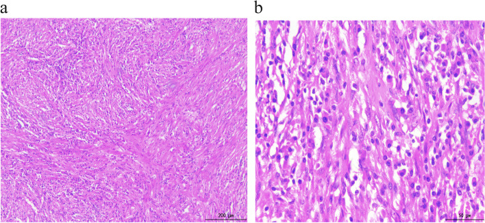 a Spindle-shaped cells arranged in fascicles in a background of chronic inflammatory cells (H&E 100×). b Spindle-shaped cells in a background of chronic inflammatory cells (H&E 400×)