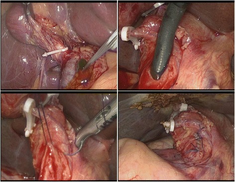 Intraoperative image of primary closure following LCBDE