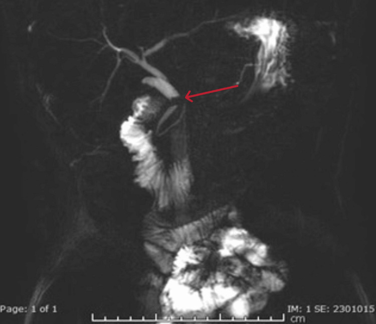 MRCP demonstrating impacted cystic duct stoneMagnetic resonance cholangiopancreatography (MRCP) reveals an impacted cystic duct stone (red arrow) causing luminal narrowing of the distal common bile duct (CBD). Associated dilatation of the proximal CBD and intrahepatic biliary ducts is evident.
