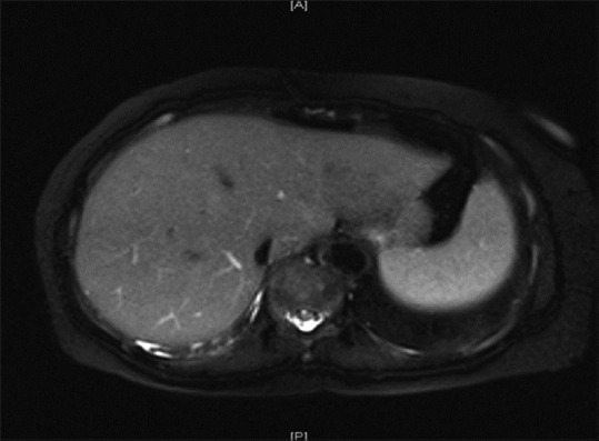 MRCP showing no definite abnormality within liver
