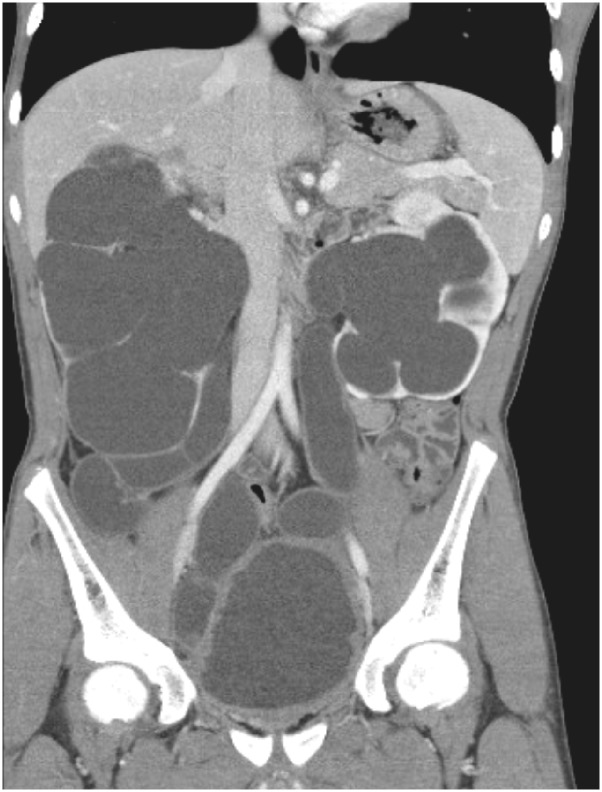 Computed tomographic findings. Severe hydronephrosis and hydroureter in both kidneys with obstructive lesion in both ureters.