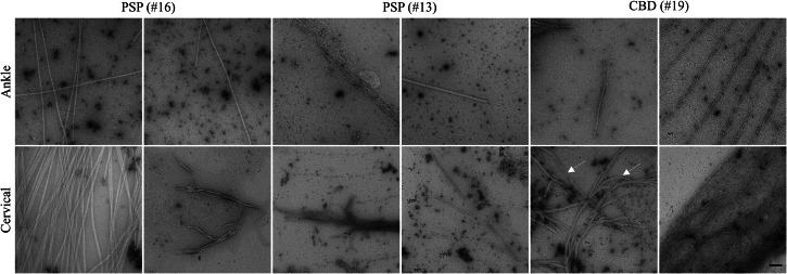 TauK18-SAA end-products.TEM images of TauK18-SAA end-products from ankle and cervical sites in PSP and CBD subjects. Arrows indicate different morphologies of tau fibrils within the same patient and anatomical site. Scale bar 100nm.