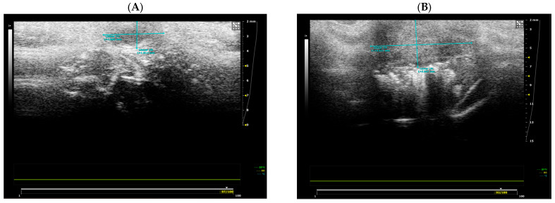 Comparative aspects of ultrasonography-assessed tumors at baseline (A) and the end of the treatment period (B). Tumor dimensions were measured using the ultrasound system caliper tool (blue lines), indicating the anteroposterior and craniocaudal diameters (mm). Tumors appear as non-homogeneous structures with irregular extensions in the mammary gland.